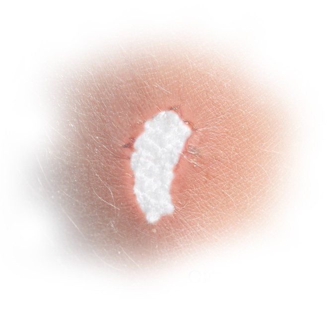 CSM - Collagen Scaffolding Matrix